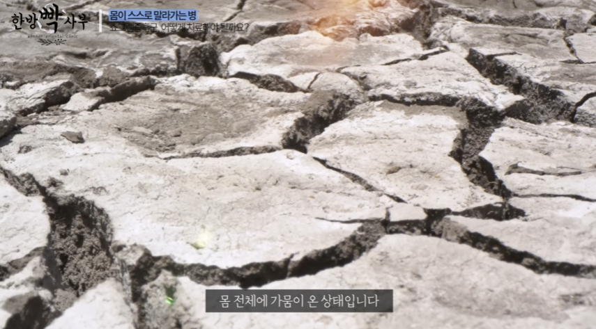 쇼그렌증후군 진단3